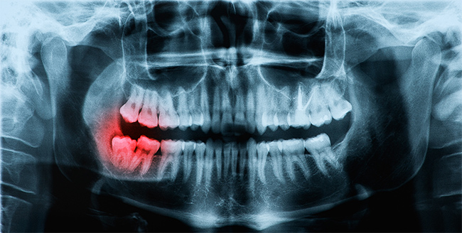 FOSI wisdom teeth xray extraction