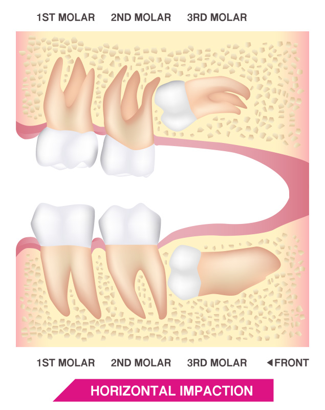 FOSI-wisdom-tooth-3 FOSI Wisdom Teeth - Horizontal Impaction