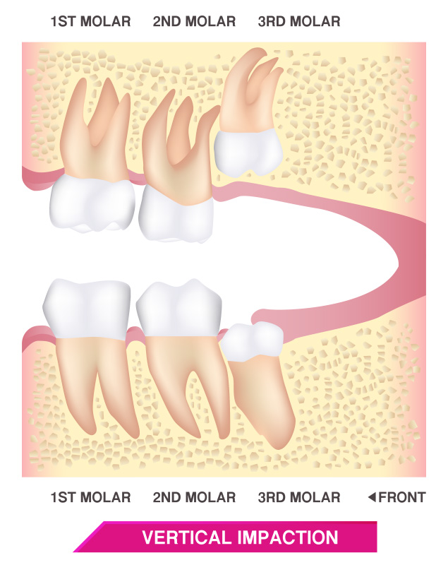FOSI-wisdom-tooth-6 FOSI Wisdom Teeth - Vertical Impaction